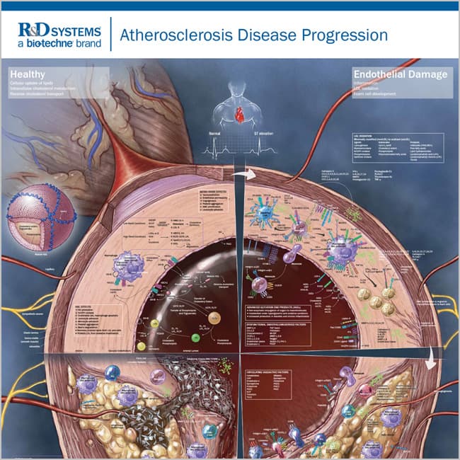 Cardiovascular Biology Atherosclerosis Disease Progression Diagram